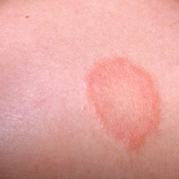 Circular Rash On Neck Pictures Photos